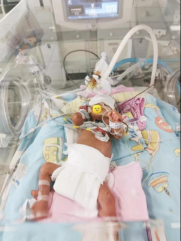 家庭参与式护理救治"巴掌大"早产儿! - 黔南热线